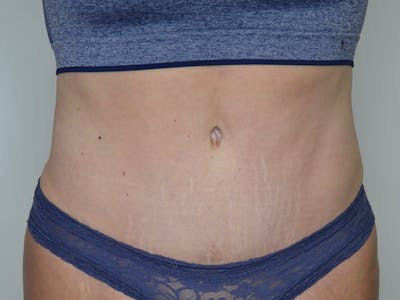 Tummy Tuck Before & After Gallery - Patient 148627 - Image 2