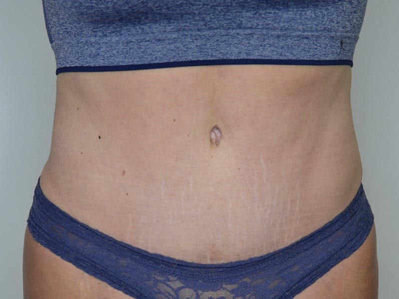 Tummy Tuck Before & After Gallery - Patient 148627 - Image 2