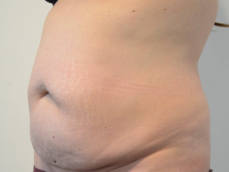 Tummy Tuck Before & After Gallery - Patient 148627 - Image 3