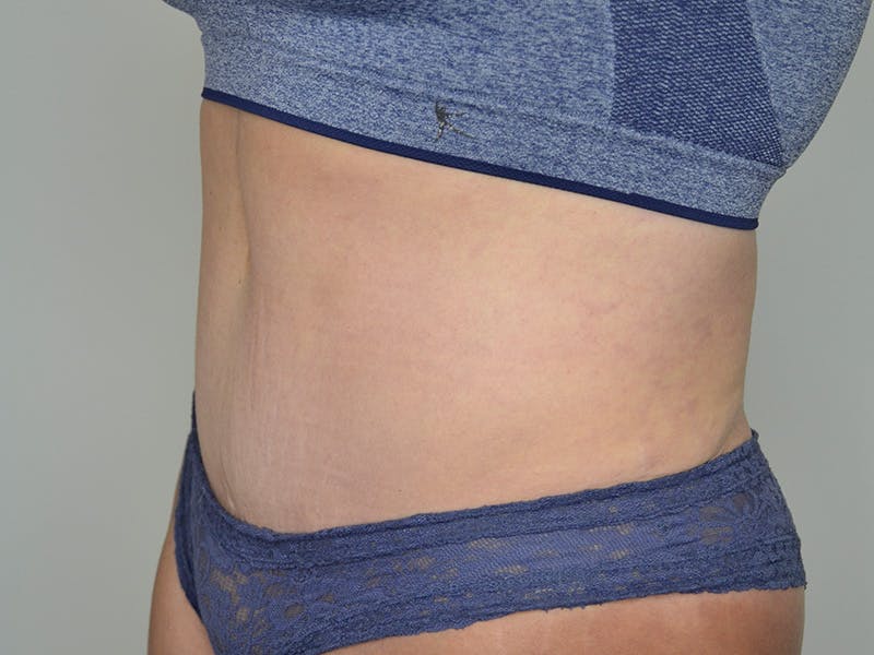 Tummy Tuck Before & After Gallery - Patient 148627 - Image 4
