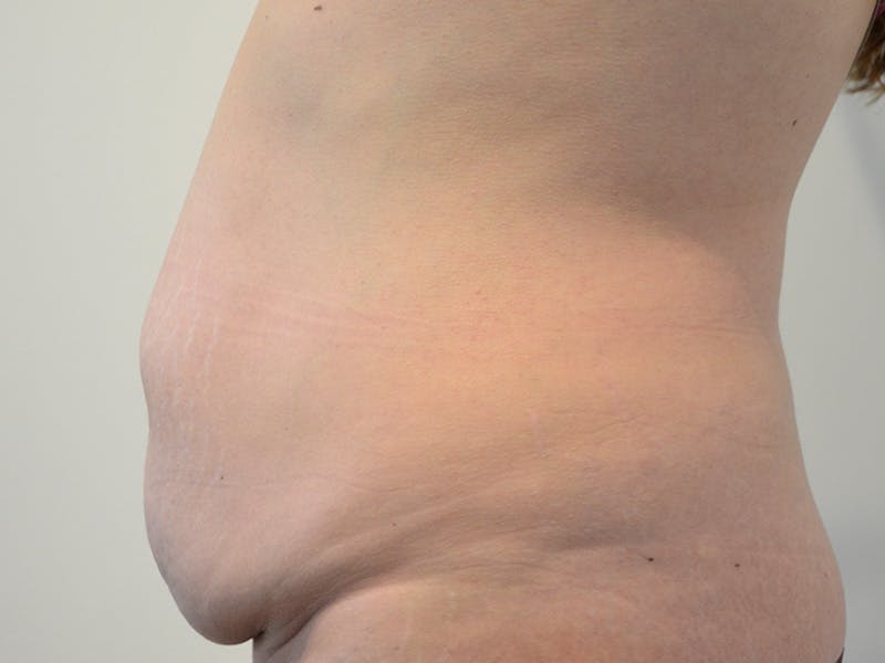 Tummy Tuck Before & After Gallery - Patient 148627 - Image 5