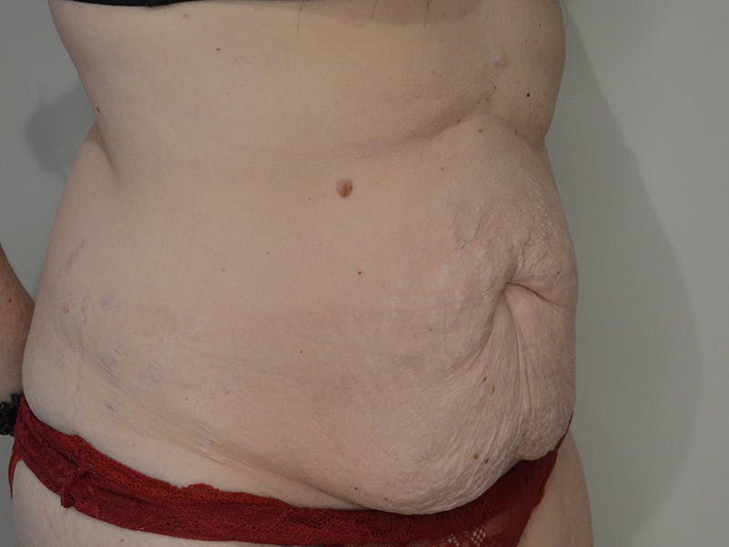Tummy Tuck Before & After Gallery - Patient 209143 - Image 3