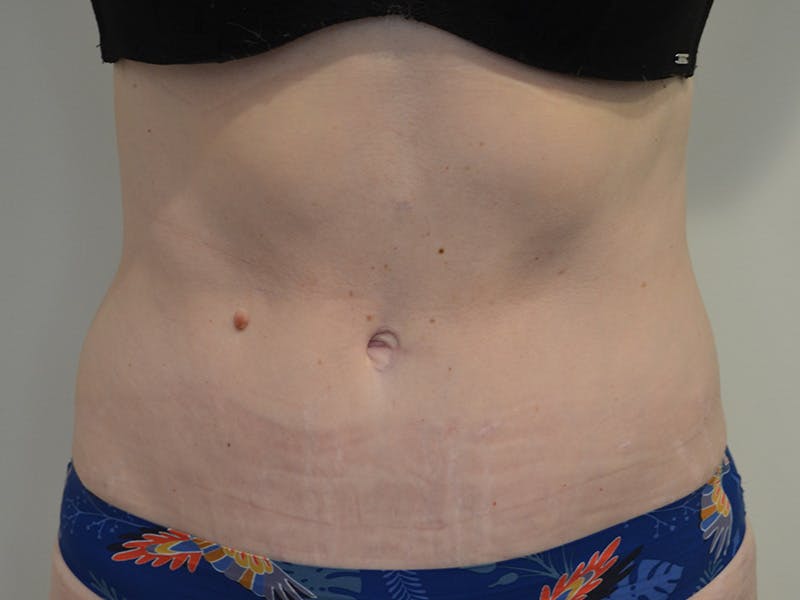 Tummy Tuck Before & After Gallery - Patient 209143 - Image 2