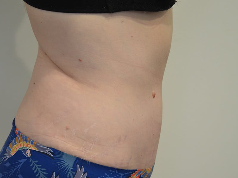 Tummy Tuck Before & After Gallery - Patient 209143 - Image 6