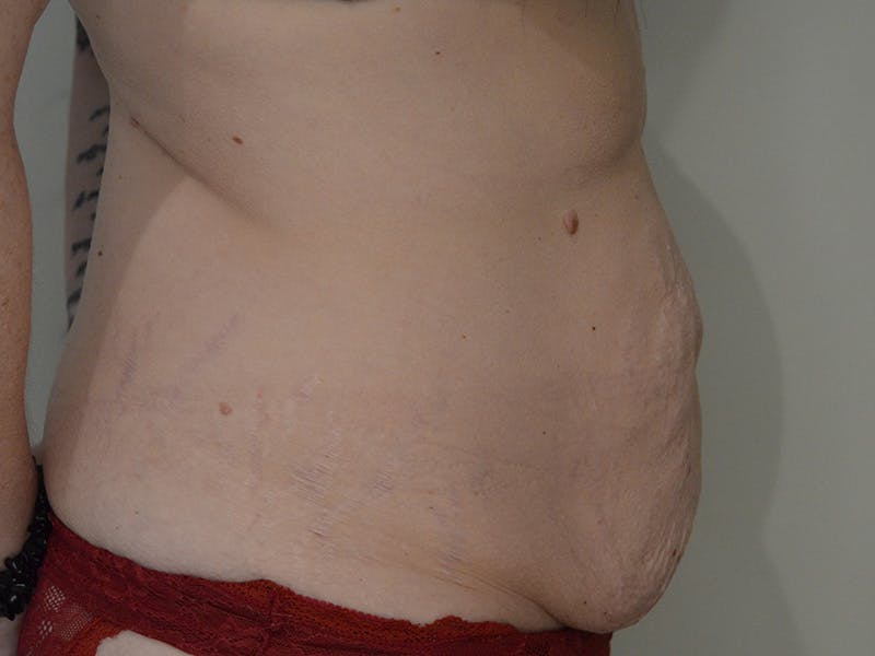 Tummy Tuck Before & After Gallery - Patient 209143 - Image 5