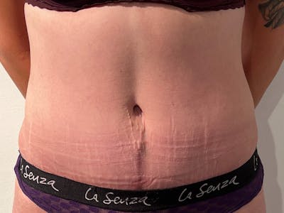 Tummy Tuck Before & After Gallery - Patient 347825 - Image 2