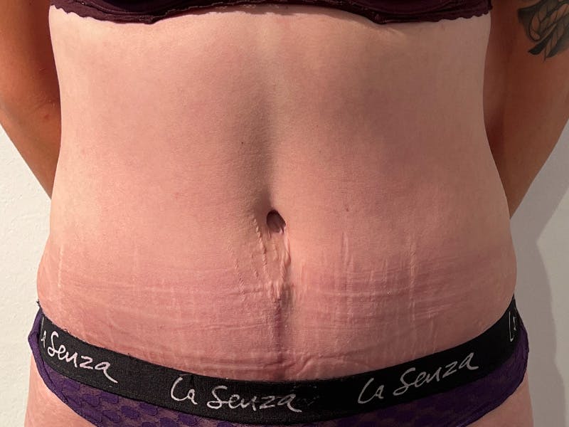 Tummy Tuck Before & After Gallery - Patient 347825 - Image 2