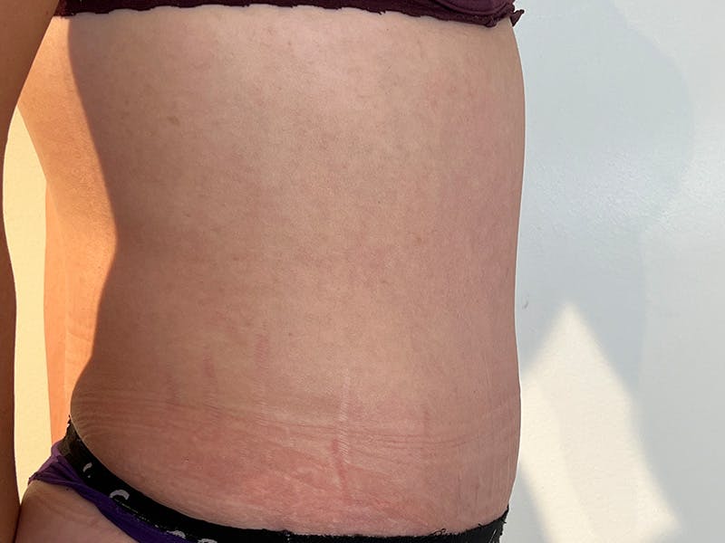 Tummy Tuck Before & After Gallery - Patient 347825 - Image 6