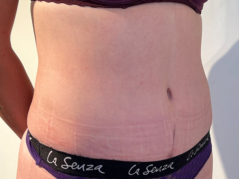 Tummy Tuck Before & After Gallery - Patient 347825 - Image 4