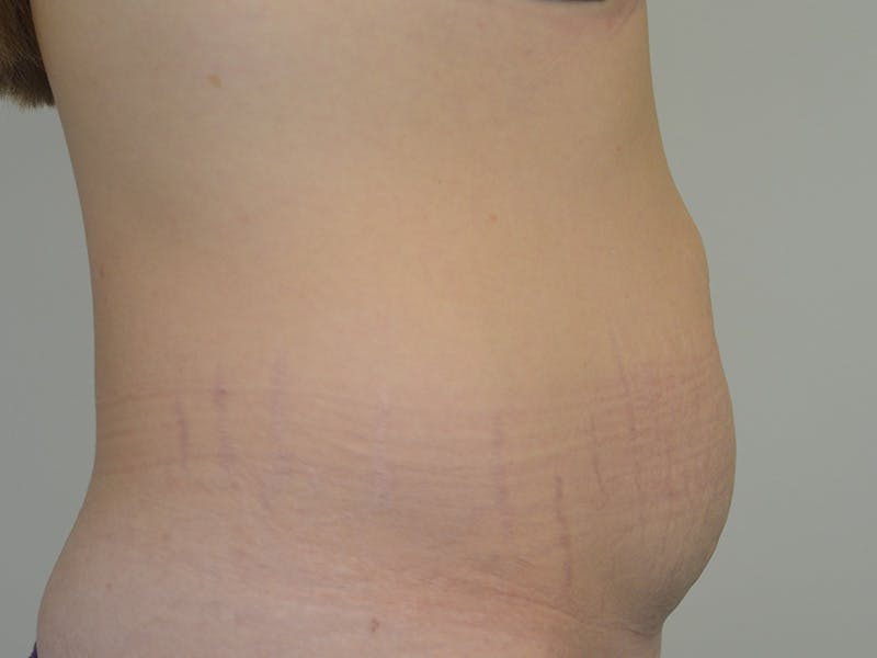 Tummy Tuck Before & After Gallery - Patient 347825 - Image 5