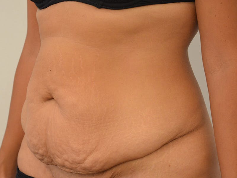 Tummy Tuck Before & After Gallery - Patient 290394 - Image 3