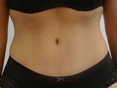 Tummy Tuck Before & After Gallery - Patient 290394 - Image 2