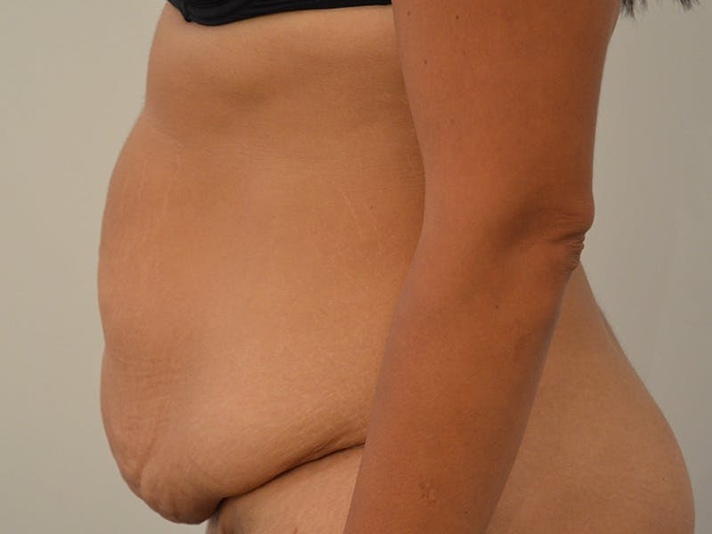 Tummy Tuck Before & After Gallery - Patient 290394 - Image 5