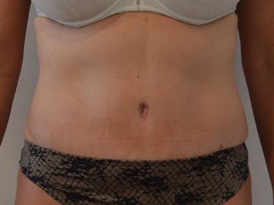 Tummy Tuck Before & After Gallery - Patient 317484 - Image 2