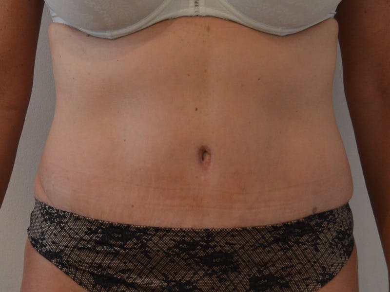 Tummy Tuck Before & After Gallery - Patient 317484 - Image 2