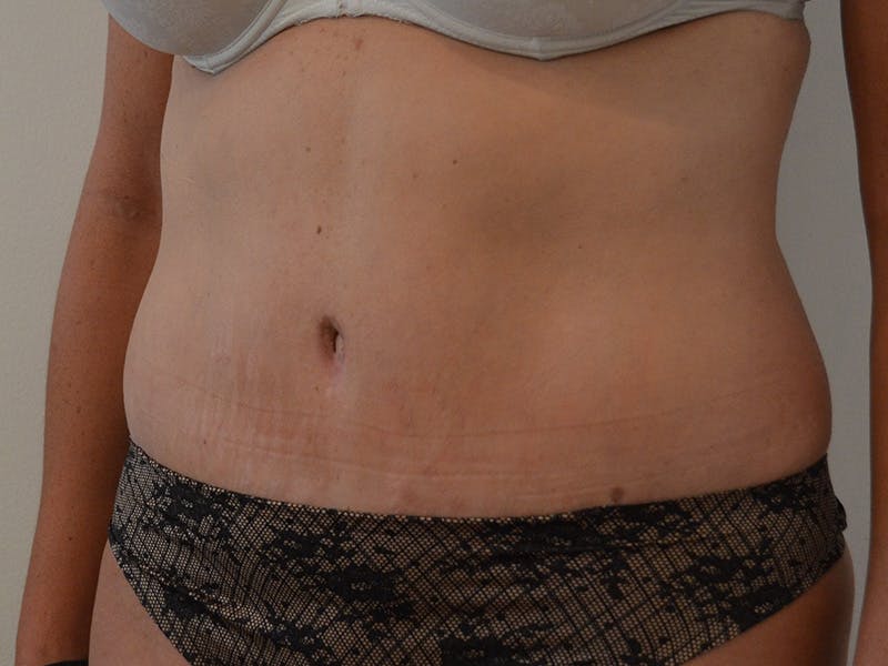 Tummy Tuck Before & After Gallery - Patient 317484 - Image 4
