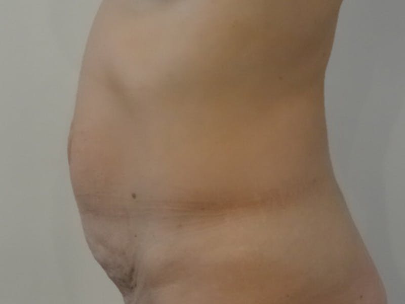 Tummy Tuck Before & After Gallery - Patient 317484 - Image 5