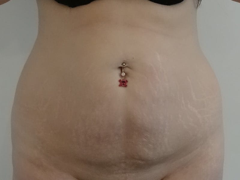 Tummy Tuck Before & After Gallery - Patient 367663 - Image 1