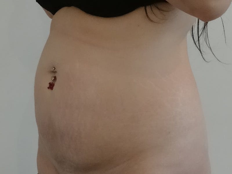 Tummy Tuck Before & After Gallery - Patient 367663 - Image 3