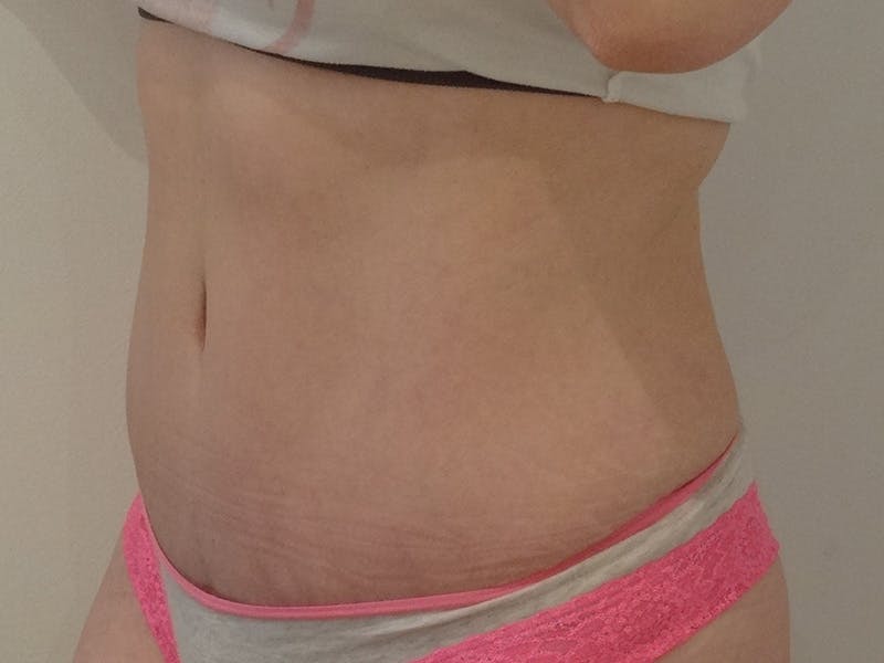 Tummy Tuck Before & After Gallery - Patient 367663 - Image 4