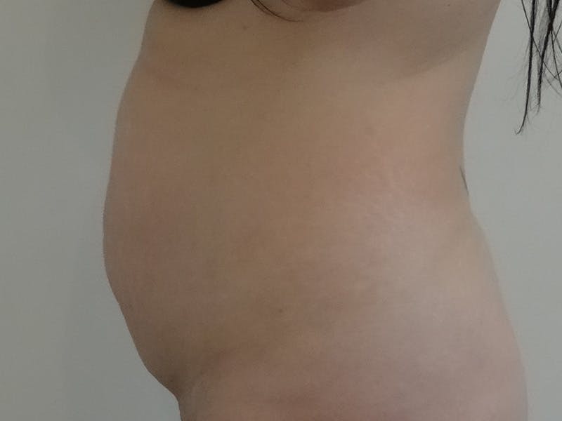 Tummy Tuck Before & After Gallery - Patient 367663 - Image 5