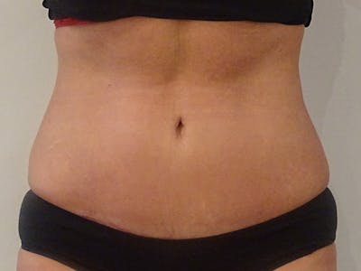 Tummy Tuck Before & After Gallery - Patient 418299 - Image 2