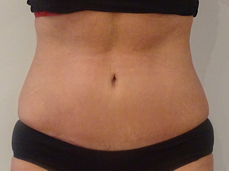 Tummy Tuck Before & After Gallery - Patient 418299 - Image 2