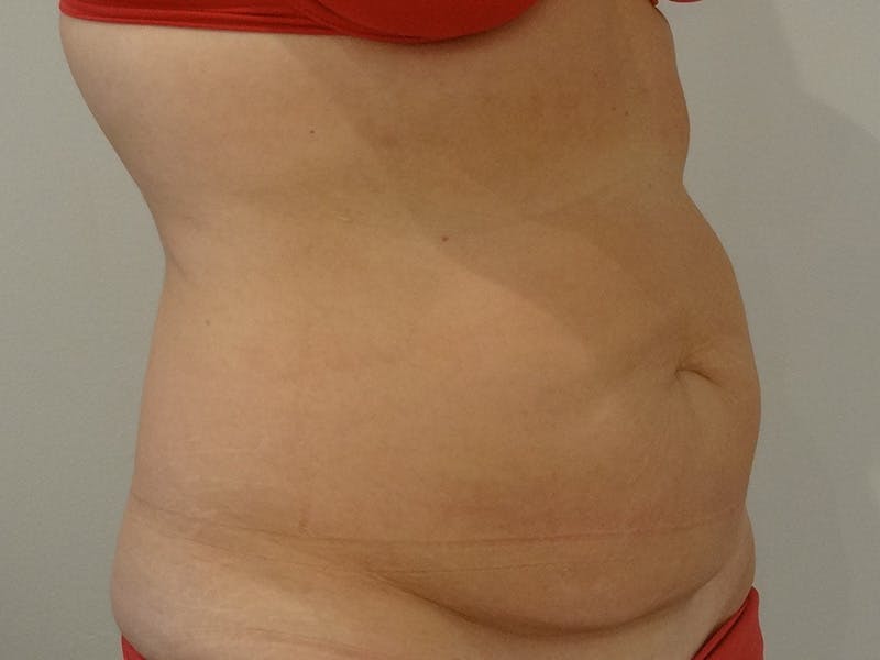 Tummy Tuck Before & After Gallery - Patient 418299 - Image 3