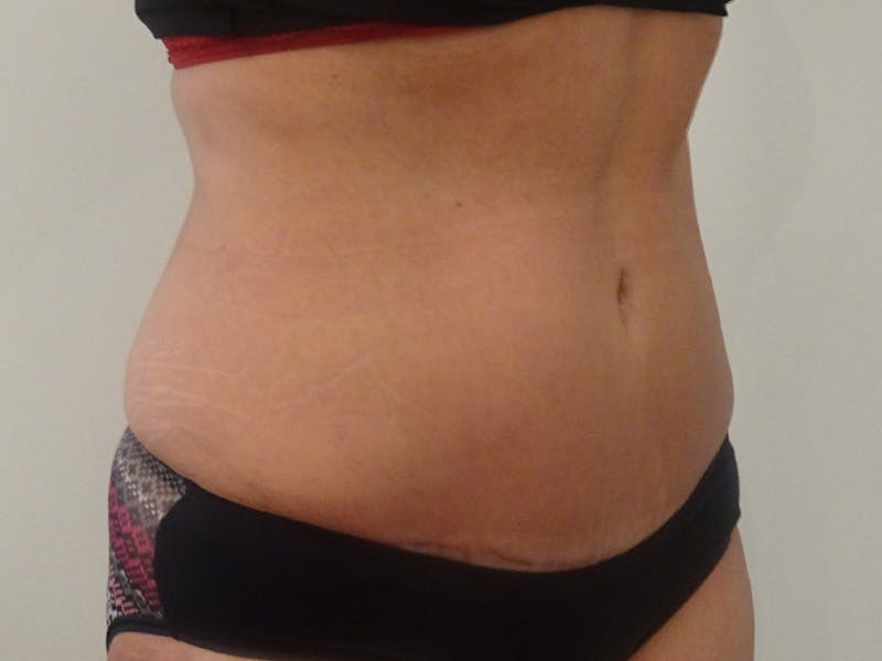Tummy Tuck Before & After Gallery - Patient 418299 - Image 4