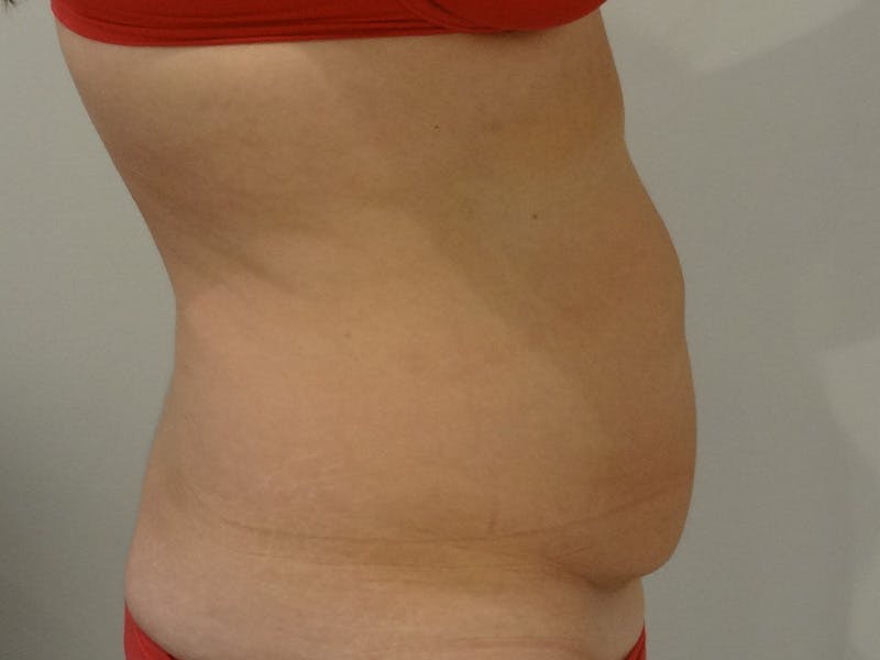 Tummy Tuck Before & After Gallery - Patient 418299 - Image 5