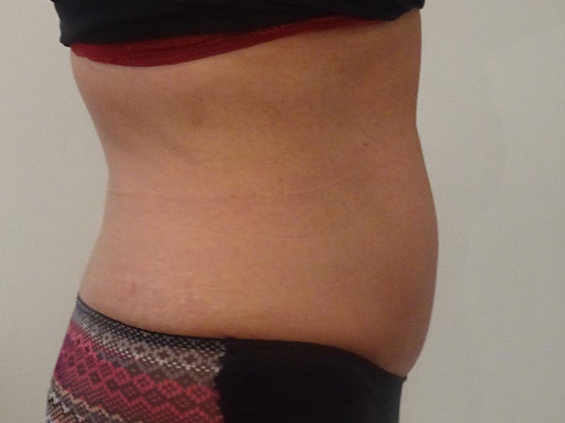 Tummy Tuck Before & After Gallery - Patient 418299 - Image 6