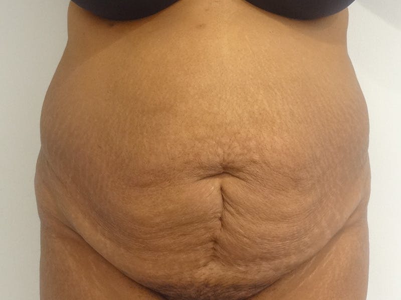 Tummy Tuck Before & After Gallery - Patient 348401 - Image 1