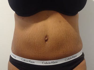 Tummy Tuck Before & After Gallery - Patient 348401 - Image 2