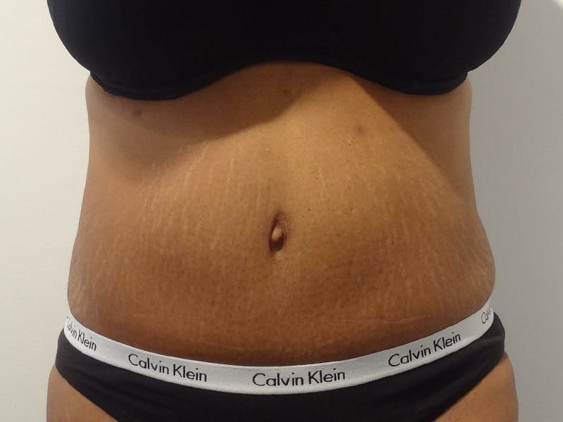 Tummy Tuck Before & After Gallery - Patient 348401 - Image 2