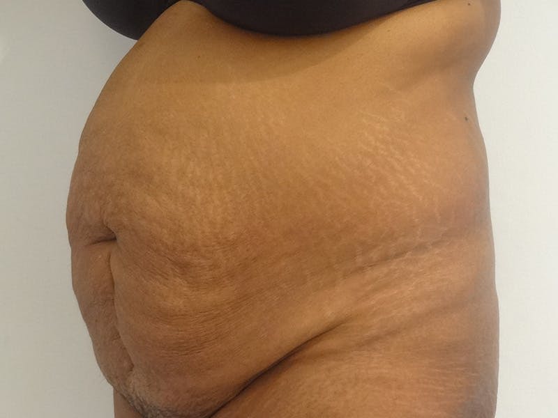 Tummy Tuck Before & After Gallery - Patient 348401 - Image 3