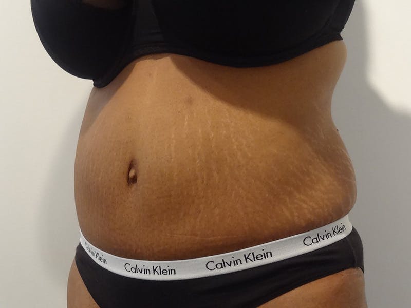 Tummy Tuck Before & After Gallery - Patient 348401 - Image 4