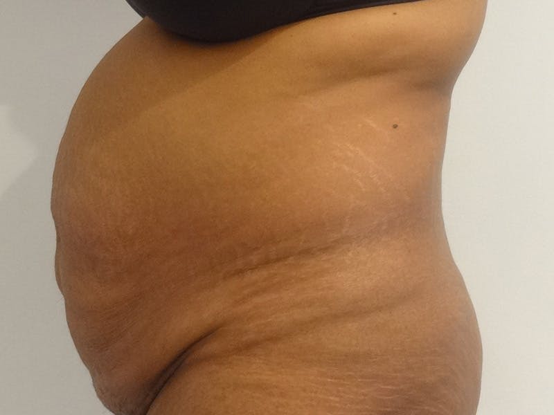 Tummy Tuck Before & After Gallery - Patient 348401 - Image 5