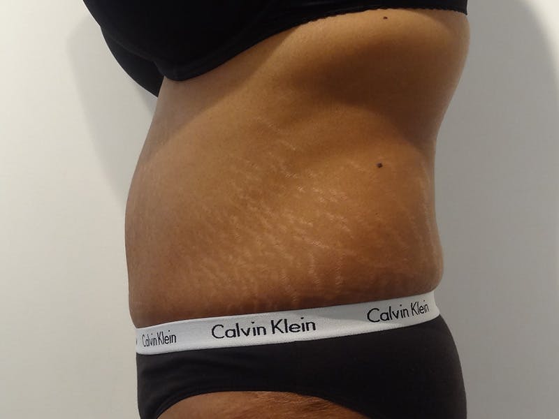 Tummy Tuck Before & After Gallery - Patient 348401 - Image 6