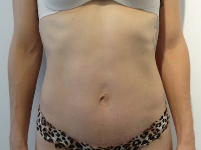 Tummy Tuck Before & After Gallery - Patient 269524 - Image 2