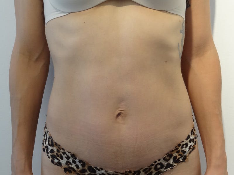 Tummy Tuck Before & After Gallery - Patient 269524 - Image 2