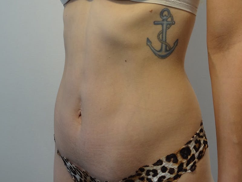 Tummy Tuck Before & After Gallery - Patient 269524 - Image 4