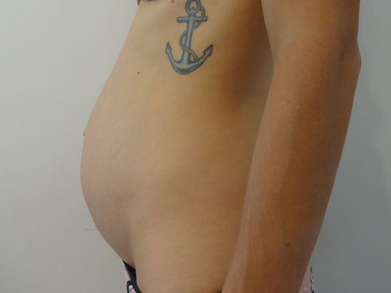 Tummy Tuck Before & After Gallery - Patient 269524 - Image 5
