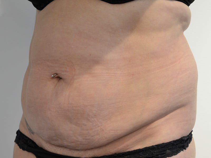 Tummy Tuck Before & After Gallery - Patient 106116 - Image 3