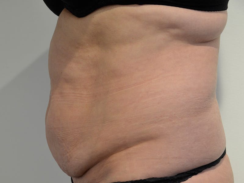 Tummy Tuck Before & After Gallery - Patient 106116 - Image 5