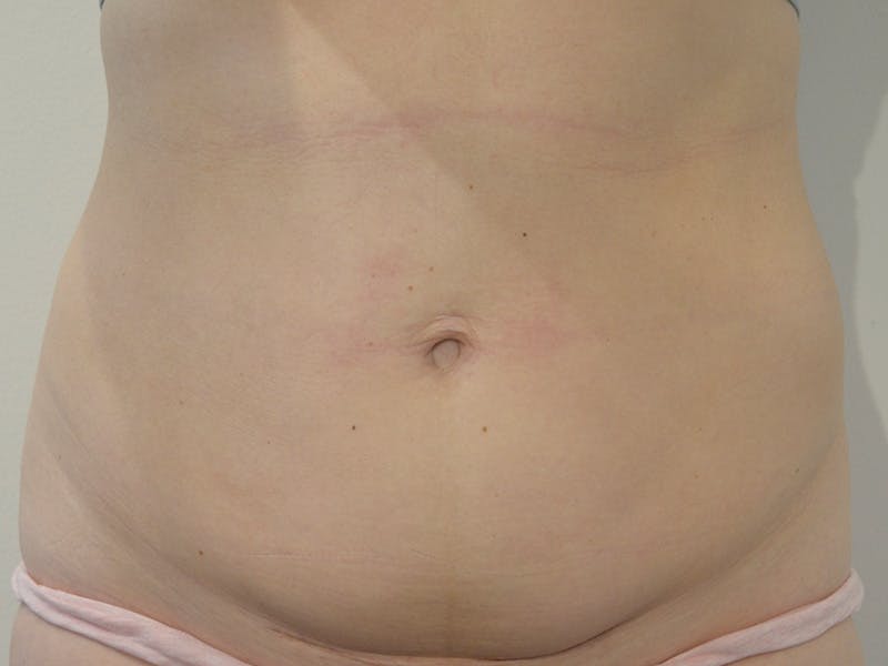 Tummy Tuck Before & After Gallery - Patient 229226 - Image 1