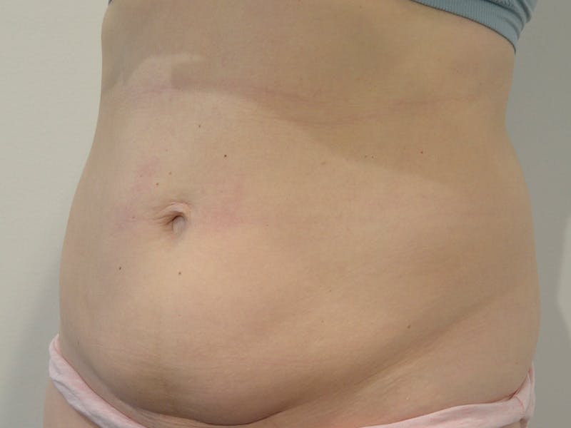 Tummy Tuck Before & After Gallery - Patient 229226 - Image 3