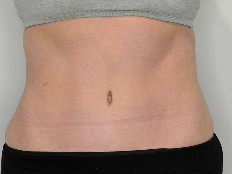 Tummy Tuck Before & After Gallery - Patient 229226 - Image 2