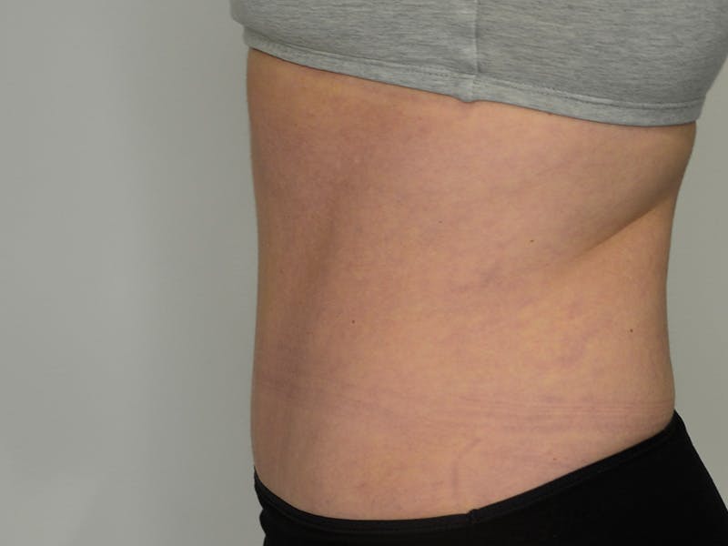 Tummy Tuck Before & After Gallery - Patient 229226 - Image 6