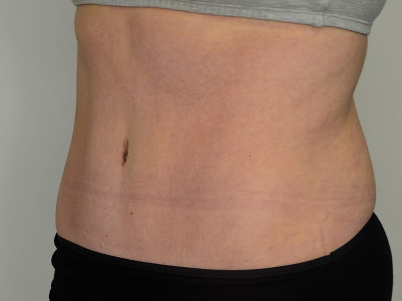 Tummy Tuck Before & After Gallery - Patient 229226 - Image 4