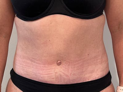 Tummy Tuck Before & After Gallery - Patient 100600 - Image 2